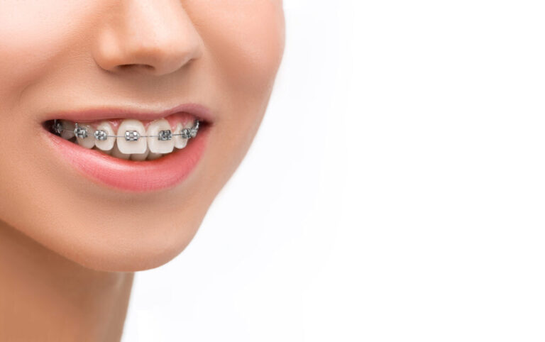 En Puente Alto puedes tener frenillos por $29.990