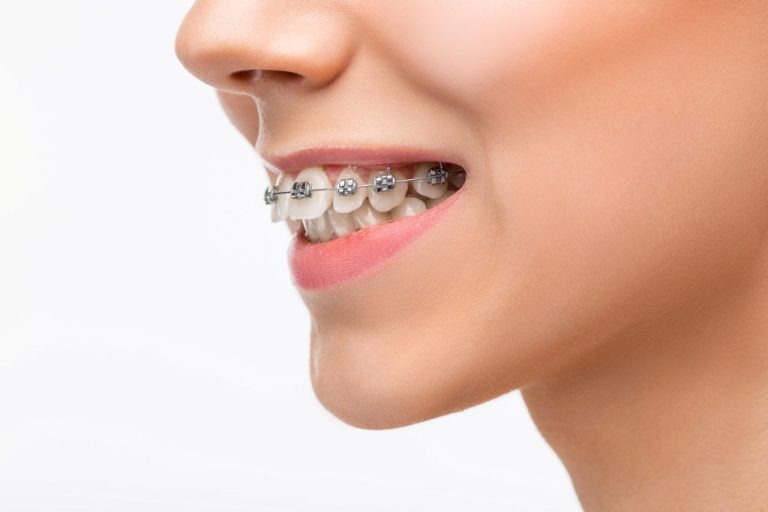 La navidad llegó a Ortosonrisa: Brackets a $29.999